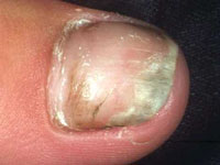 Fungal Nail Infections, Causes, Symptoms & Treatment