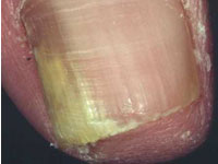 Fungal Nail Infections, Causes, Symptoms & Treatment